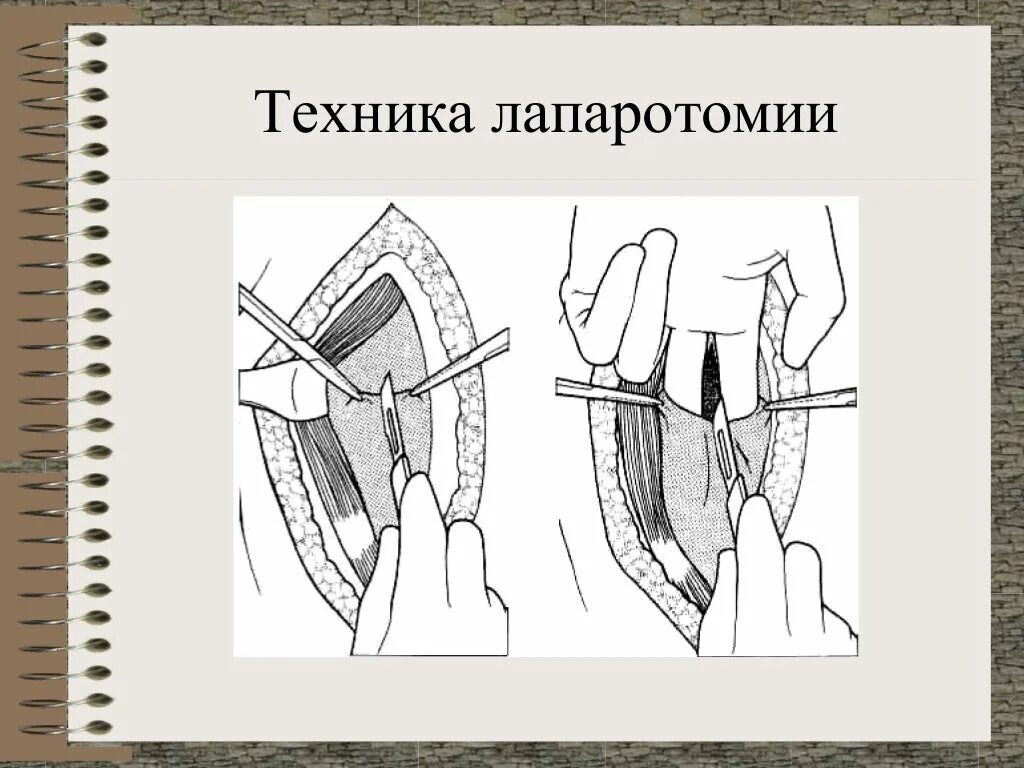 Какое лапаротомия. Пфанненштилю лапаротомия. Средняя срединная лапаротомия. Нижнесрединная лапаротомия разрез. Продольная лапаротомия.