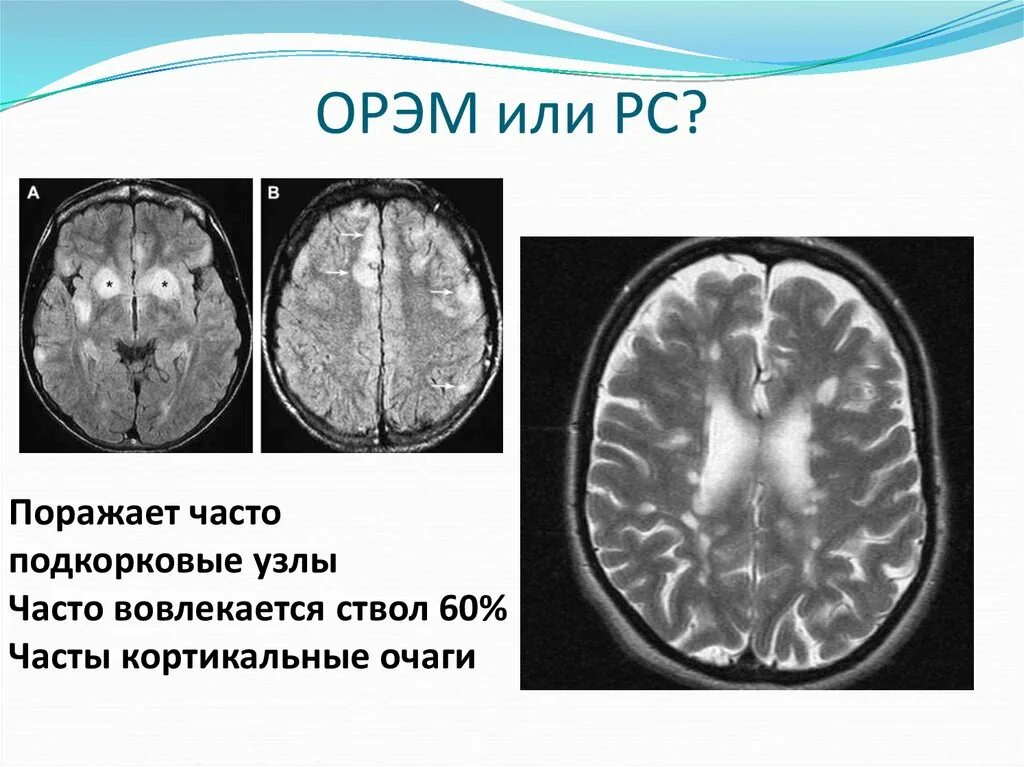 Острый рассеянный энцефаломиелит (орэм). Орэм неврология. Ценовые зоны электроэнергии. Субъекты оптового рынка электрической энергии. Орэм это.