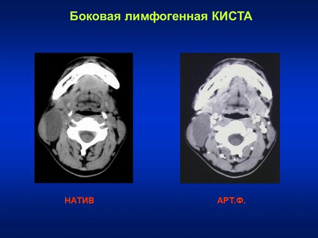 Бранхиогенная киста шеи кт. Кт миндалин