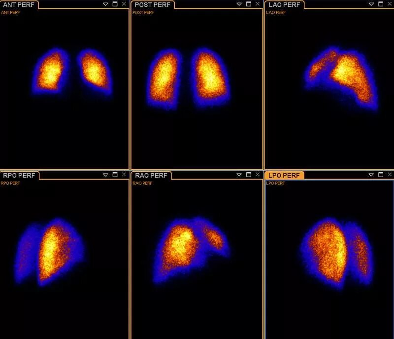 Исследование изотопами. Радиоизотопный метод сцинтиграфия. Сцинтиграфия грудной клетки. Статическая сцинтиграфия легких. Сцинтиграфия легких исследование перфузии.