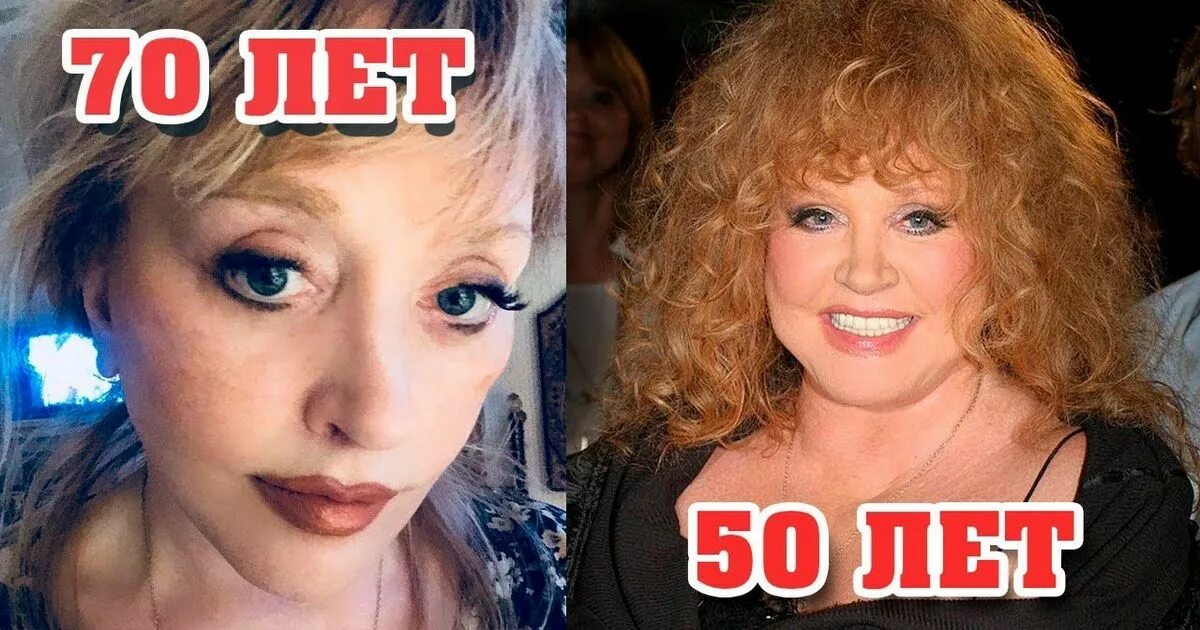 Алла пугачева пластика. Пугачева после пластики. Пугачева после пластики. Пластические операции пугачева алла пугачева. Алла пугачёва пластика 2023.