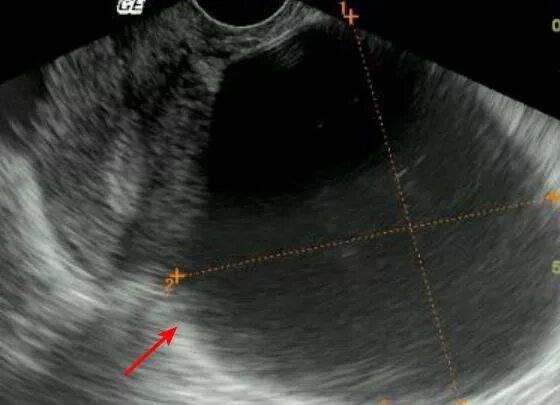 Псевдомуцинозная кистома яичника. Серозная цистаденома яичника на УЗИ. Киста яичника серозная цистаденома. УЗИ серозной папиллярной цистаденомы. Киста яичника с перегородками
