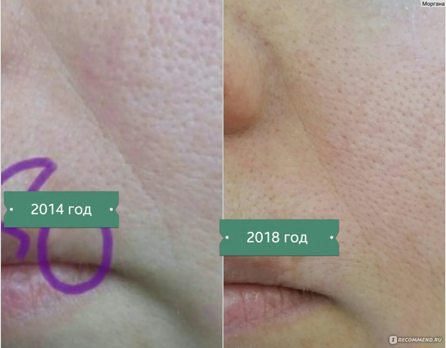 Микротоки лицо до и после фото отзывы. Микротоки для лица до и после. аппарат для микротоков до и после. лицо после микротоков. микротоки в домашних условиях.