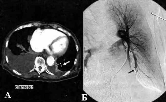 легочная ангиография