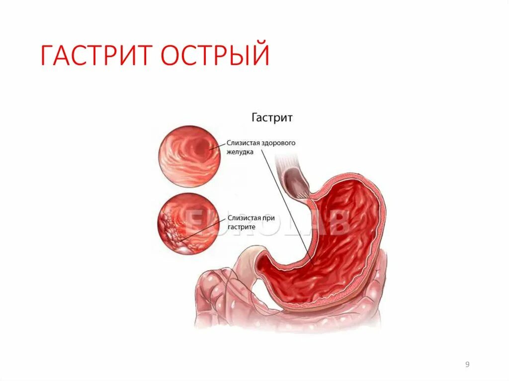 Формы острого гастрита. Гастрит воспаление слизистой оболочки. При остром гастрите в слизистой оболочке желудка развивается. Гастрит слизистой оболочки желудка воспаление. Разновидности гастритов острый и хронический.