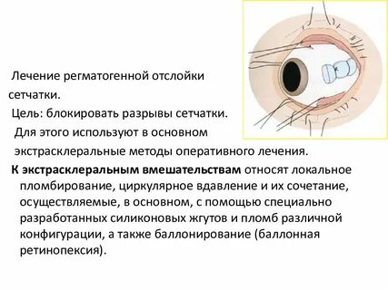Отслоение сетчатки глаза лечение