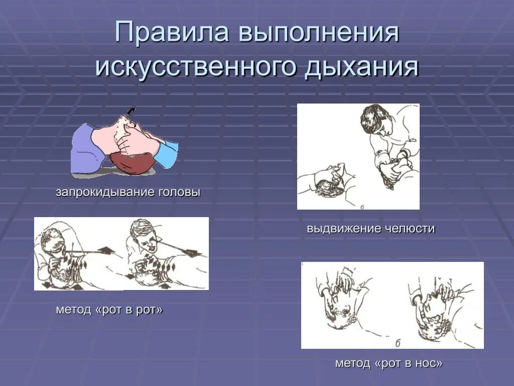 Порядок проведения искусственного дыхания. Правила выполнения искусственного дыхания. Правило выполнения искусственное дыхание. Правильность выполнения искусственного дыхания.