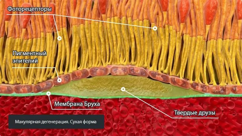 Макулярная дегенерация. Н35.3 дегенерация макулы.