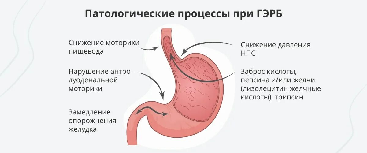 Симптомы желчи в пищеводе