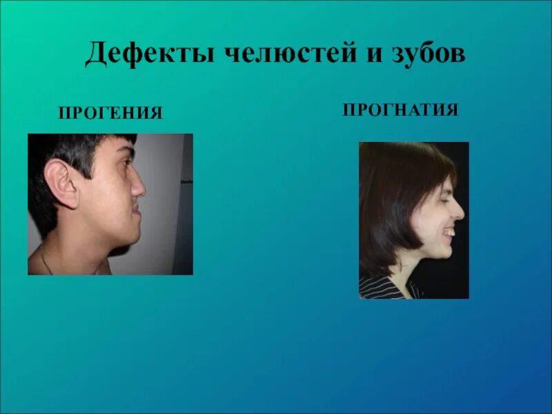Прогнатия это в логопедии. Прикус (прогнатия, прогения, открытый передний\боковой, перекрестный). Дистальный прикус ретрузия. Неправильный прикус прогения прогнатия. Прогнатия это в логопедии.