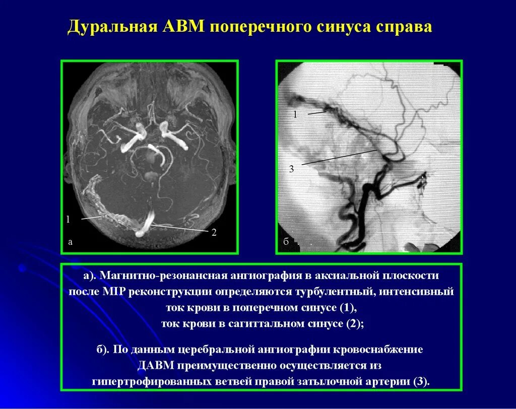 Сосудистые мальформации кт мрт. Мальформация сосудов головного мозга кт. Артериовенозные мальформации сосудов головного мозга кт. Артериовенозная мальформация сосудов головного мозга мрт. Гипоплазия правого поперечного синуса