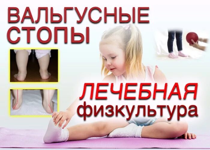 Гимнастика для стоп при вальгусной деформации у детей. Гимнастика для стоп при плоскостопии и вальгусной деформации. Лфк при вальгусе у детей. Гимнастика при вальгусной деформации стопы у детей 2. Лфк ребенку при вальгусной деформации.