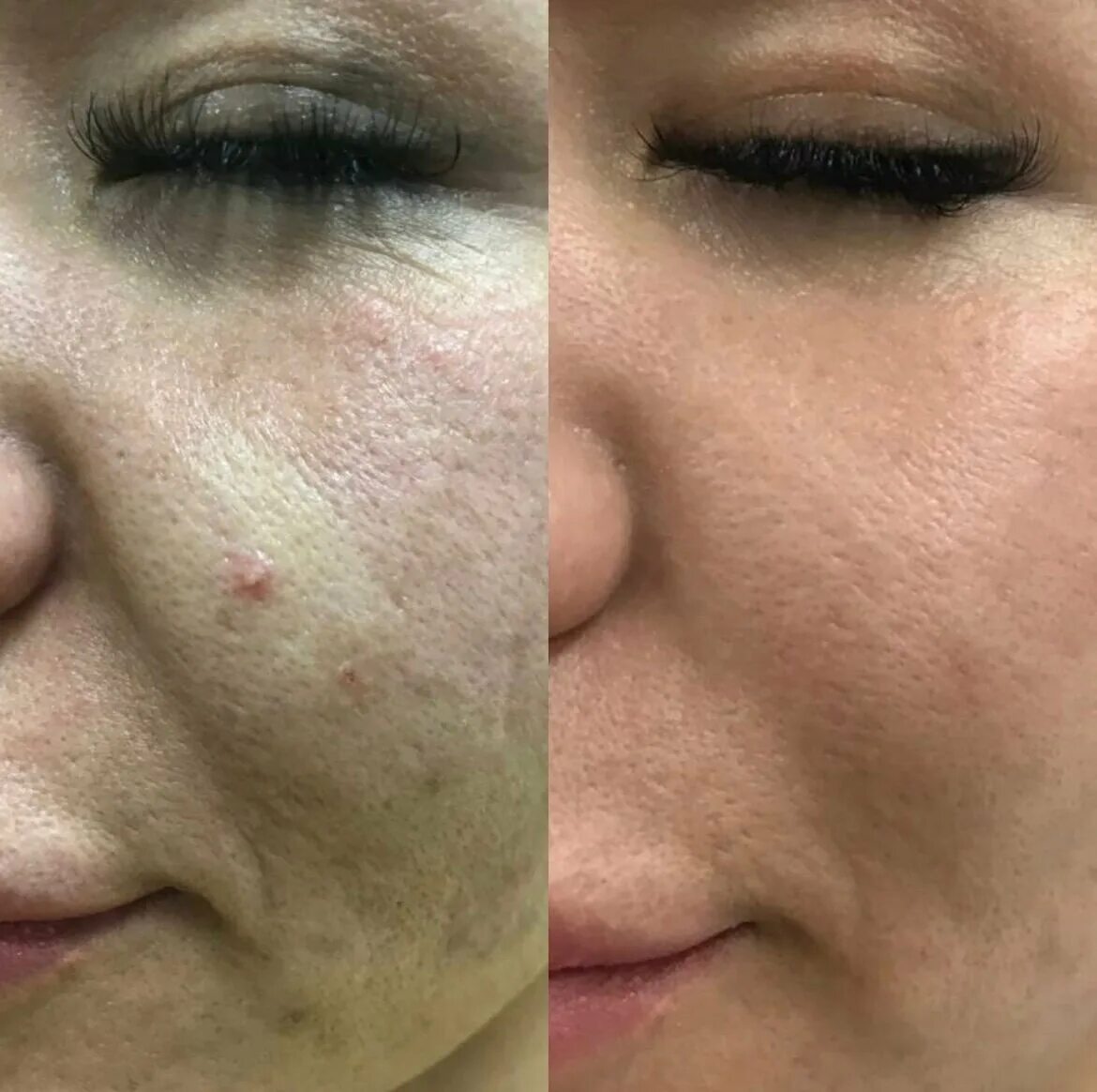 холодная плазма после процедуры. омоложение холодной плазмой. холодная плазма для лица до и после. плазменное омоложение аппарат plasma liner. омоложение холодной плазмой.