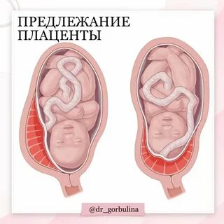 Беременность плацента по передней стенке матки