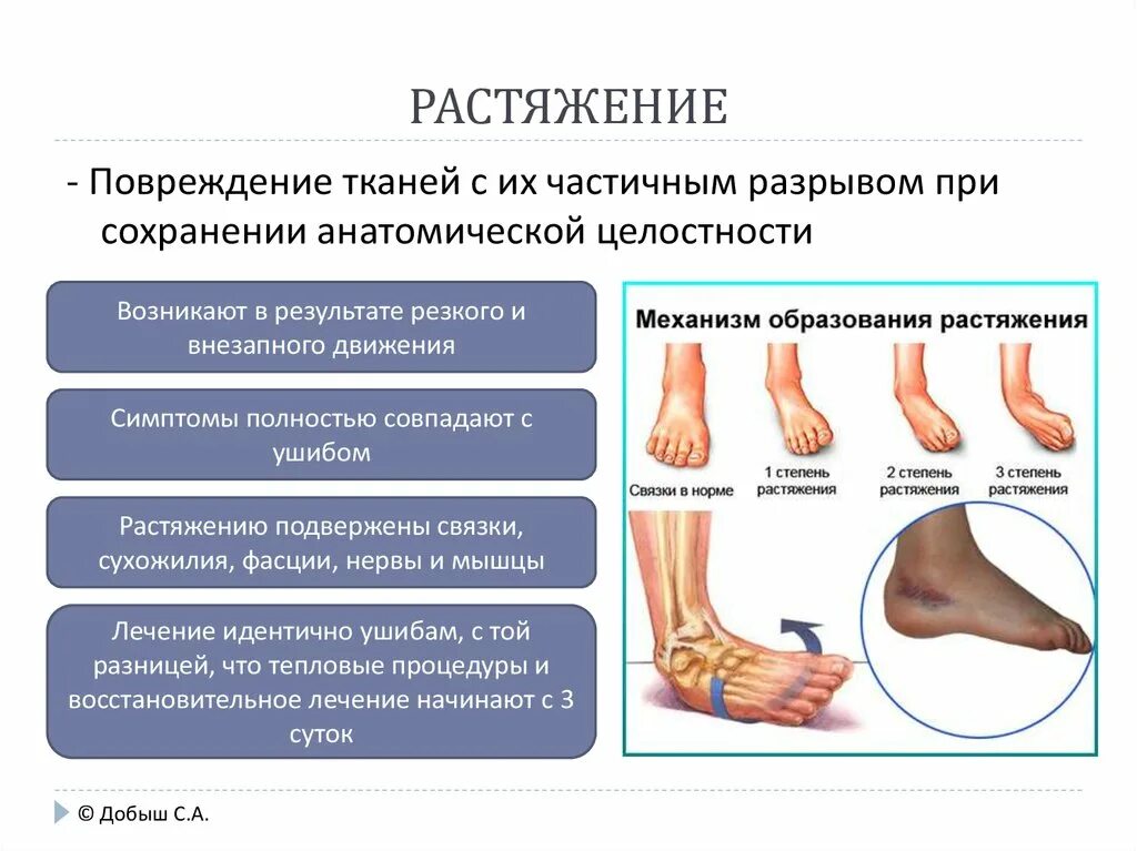 Сколько времени болят переломы. Надрыв связок голеностопного сустава гематома. Растяжение голеностопной связки 1 степени. Процесс заживление растяжение связок голеностопа. Растяжение и разрыв связок.