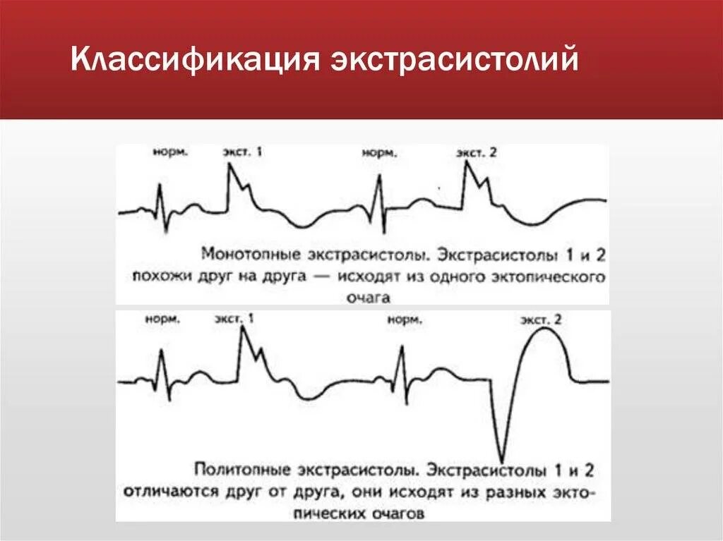 Нарушение ритма по типу экстрасистолии