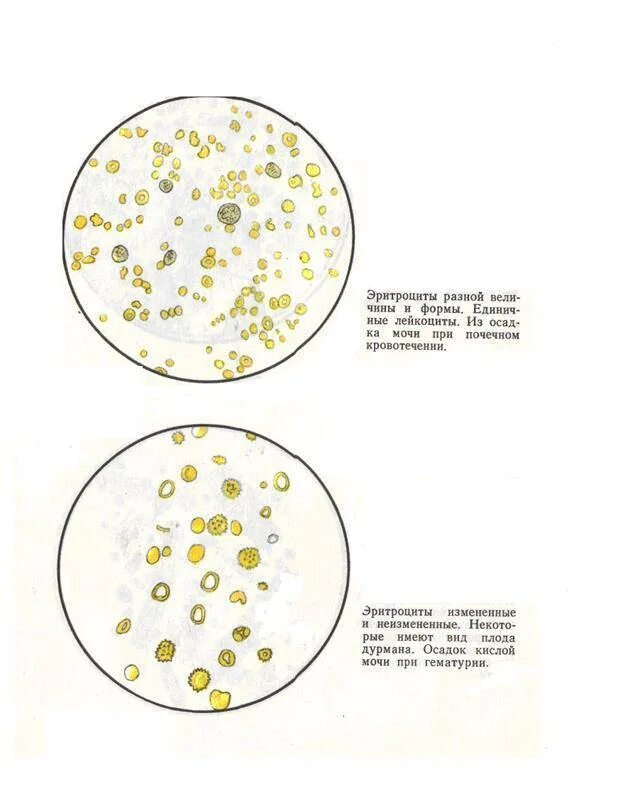 Почему повышены эритроциты в моче. Лейкоциты и эритроциты в моче микроскопия. Микроскопия мочи под микроскопом лейкоциты и эритроциты. Лейкоциты в моче микроскопия осадка. Исследование осадка мочи лейкоциты.