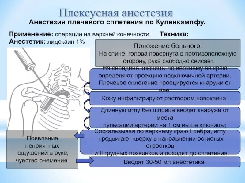 Блокада сплетения. Блокада по Куленкампфу техника. Плексусная анестезия техника. Проводниковая анестезия по Куленкампфу. Анестезия по Куленкампфу техника.