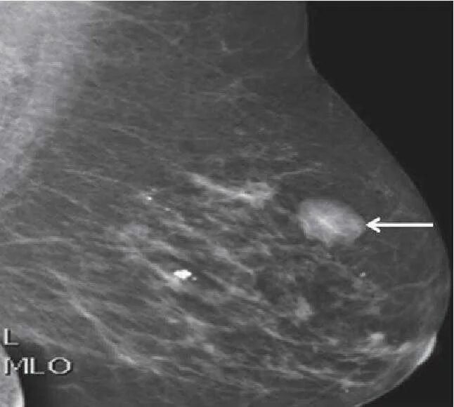 Шишка в грудной железе у женщин. Маммография фиброаденома. Фиброзно-кистозная мастопатия биопсия. Злокачественная фиброаденома молочной железы. Атипичная фиброаденома маммография.