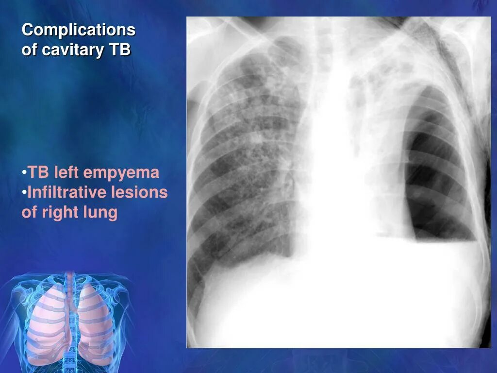 Хроническая эмпиема плевры кт. Хроническая эмпиема плевры рентген. Эмпиема плевры туберкулез. Эмпиема легкого рентген. Эмпиема легкого