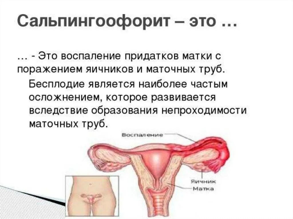 Какие симптомы при воспалении яичников у женщины. Сальпингоофорит (аднексит). воспаление яичников сальпингоофорит. воспаление левостороннего сальпингоофорита. воспаление придатков матки.