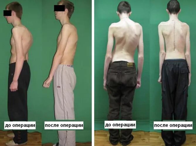 берут ли с искривлением позвоночника. кифосколиоз (болезнь шейермана-мау). сколиоз 2, 3 степени грудного отдела позвоночника. кифосколиоз 1 степени армия. берут ли с искривлением позвоночника.