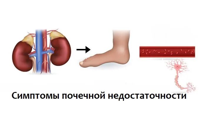 Почему отказывают почки и что происходит. Симптомы отказа почек. Отказали почки симптомы. Отказ почек симптомы у мужчин. Признаки почечной недостаточности.