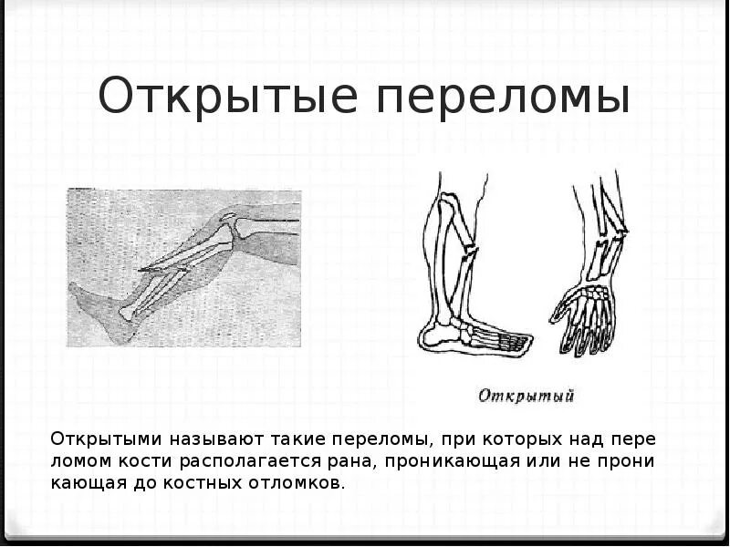 Какой вид травмы показан на рисунке. Переломы костей презентация. Открытый перелом презентация. Презентация на тему переломы. Травмы открытые переломы.