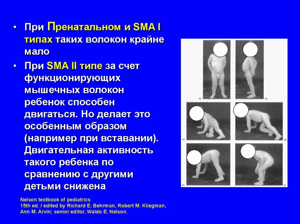 Сма 2 типа что это. Спинально-мышечная атрофия 2го типа.