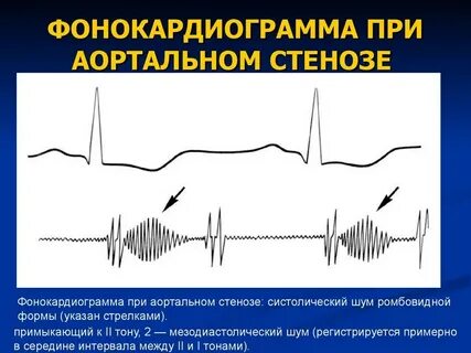 Аортальные шумы
