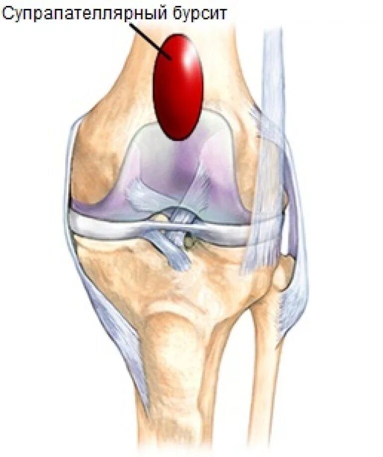 Супрапателлярная сумка коленного сустава. Препателлярный бурсит. Ретропателлярный бурсит. Препателлярный бурсит пункция.