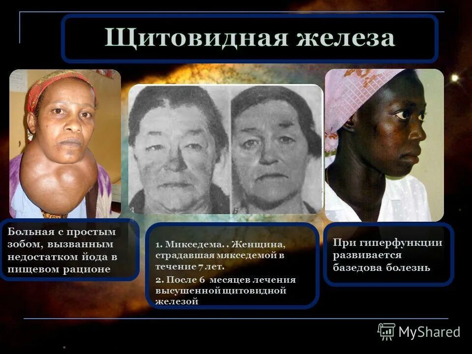 Гиперфункция желез это. Гиперфункция щитовидной железы болезнь. Гиперфункция желез это. Гиперфункция щитовидной железы вызывает. Гиперфункция желез это.