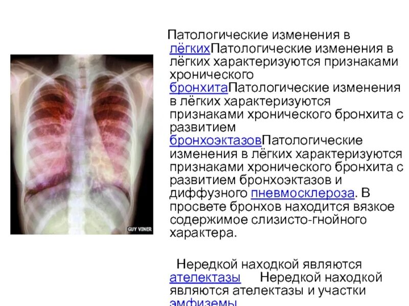 Пневмосклеротические изменения что это. Пневмосклеротические изменения что это