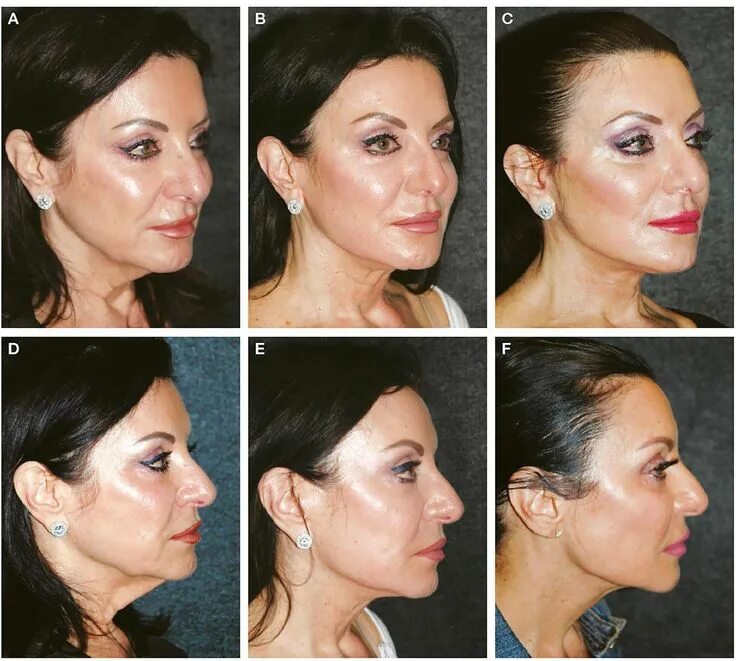 Аксесс фейслифт. Deep plane facelift. Deep plane facelift edema. Deep plane facelift. Deep plane facelift.