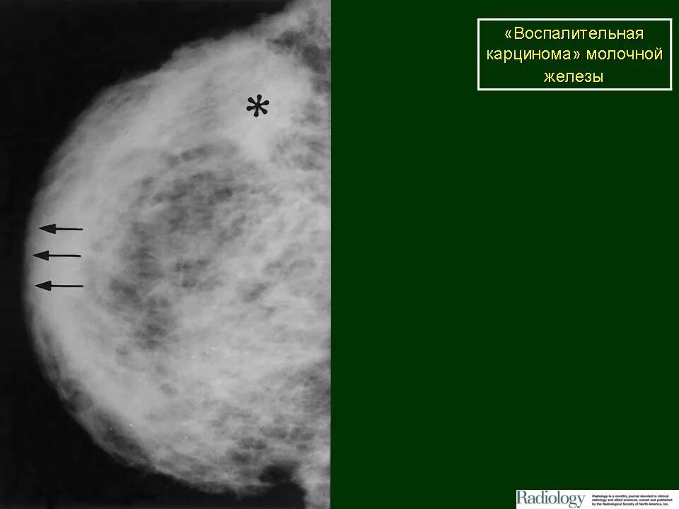 Опухоли молочных желез. Злокачественное новообразование молочной железы. Воспалительная карцинома молочной железы. Воспалительный инфильтрат в молочной железе. Онкология молочных желез симптомы