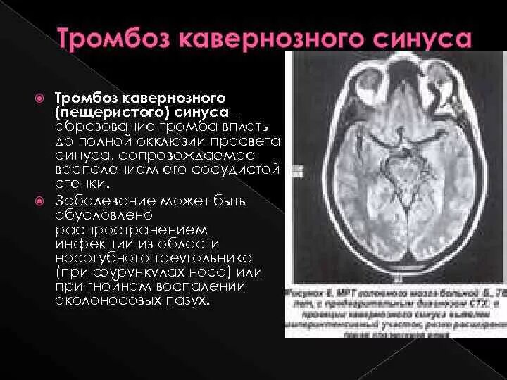 Тромбоз кавернозного синуса мрт. Тромбоз вен клетчатки орбиты, кавернозного синуса. Кавернозный синус головной мозг мрт. Кавернозный синус мрт анатомия. Мрт тромбоз