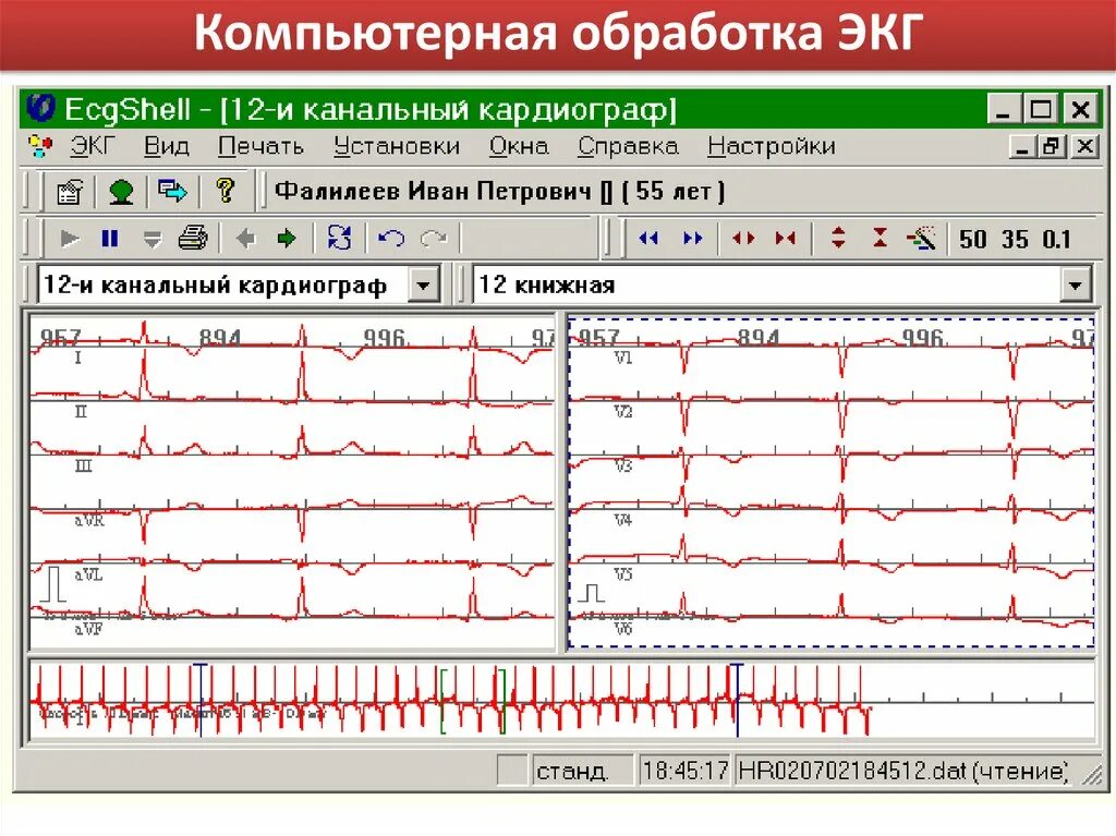 Обработка ЭКГ. Обработка электрокардиограммы. Компьютерный электрокардиограф. Компьютерный экг