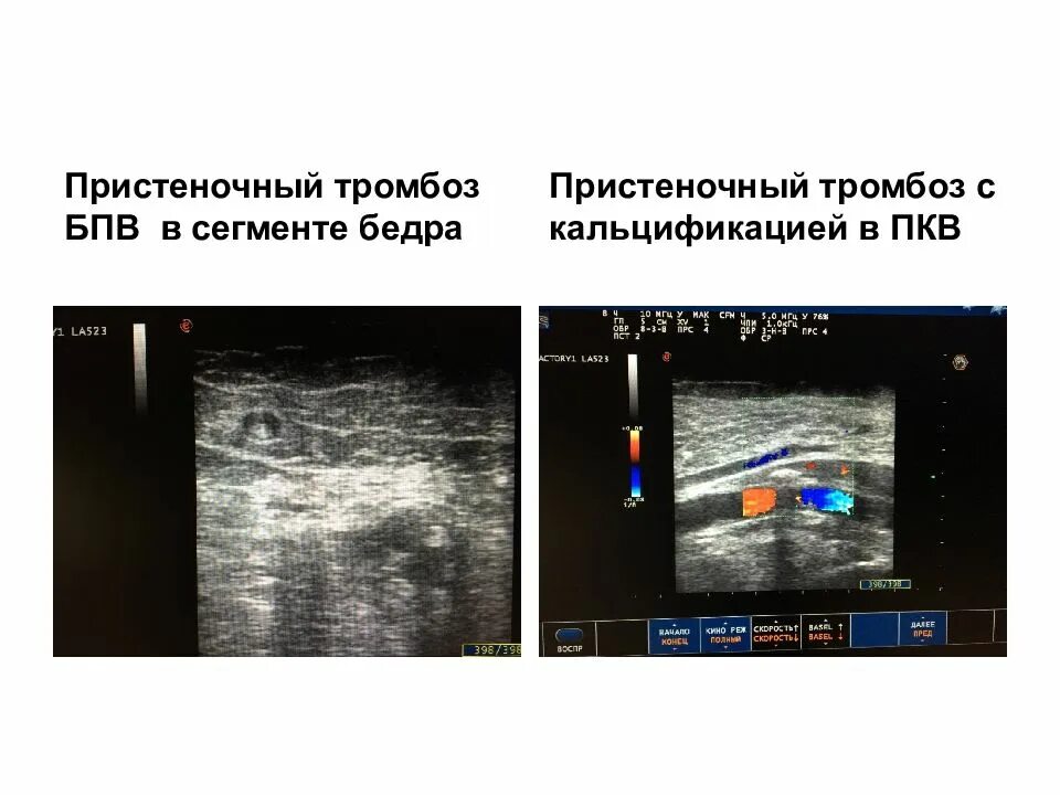 Пристеночный тромбоз БПВ. Пристеночный тромб УЗИ. Пристеночный тромбоз