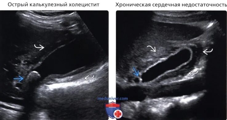 Изменение стенок желчного пузыря. Утолщение стенки желчного пузыря на УЗИ. Слоистая стенка желчного пузыря на УЗИ. Изменения стенки желчного пузыря на УЗИ. УЗИ утолщение стенок желчного.