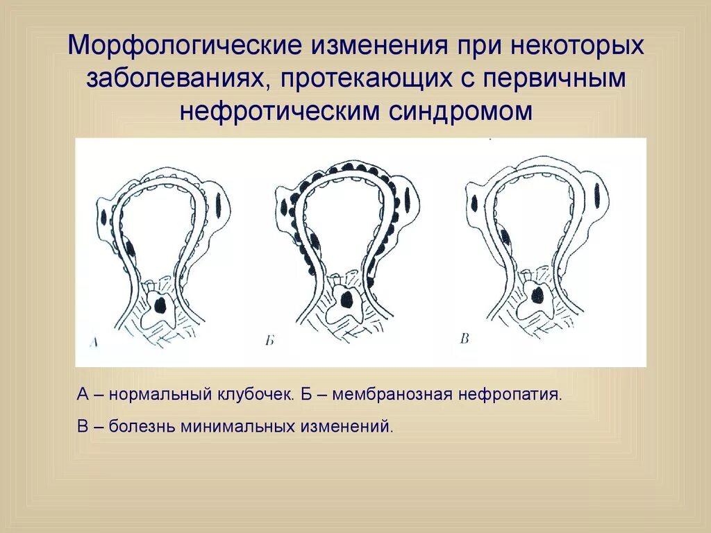 Морфологические изменения болезни. Морфологические изменения. Болезнь минимальных изменений. Морфологические изменения клубочек почек. Морфологически минимальные изменения почек.