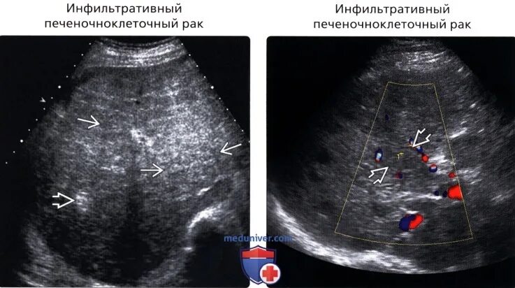 Срезы печени на УЗИ. УЗИ признаки гепатомегалии. УЗИ печени при гепатомегалии.