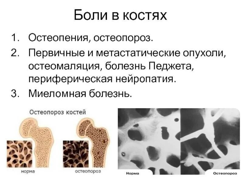 Какие бывают заболевания костей. Остеопения и остеопороз. остеопенический синдром и остеопороз. что такое остеопения костей. остеопороз губчатого вещества.