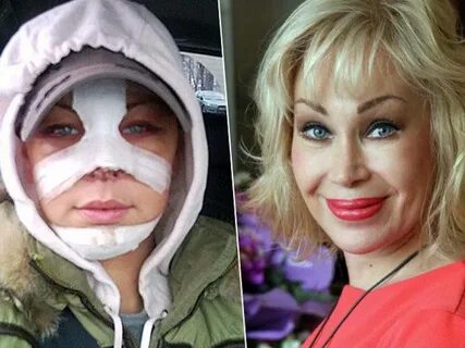 Звездочка после пластики