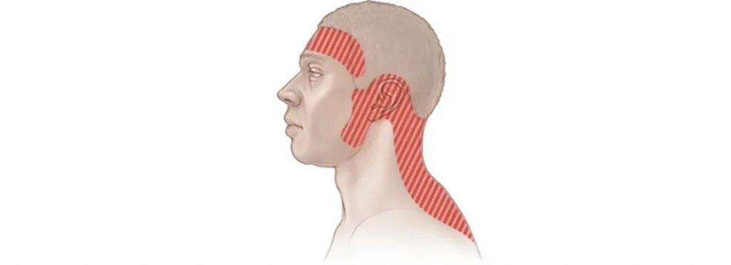 Болит голова и мышцы шеи. Головная боль напряжения. Головная боль локализация. Напряженная головная боль. Головная боль напряжения локализация.