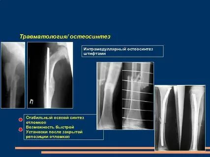 Рентген в травматологии