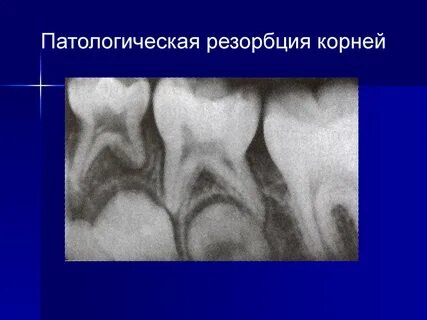 Резорбция