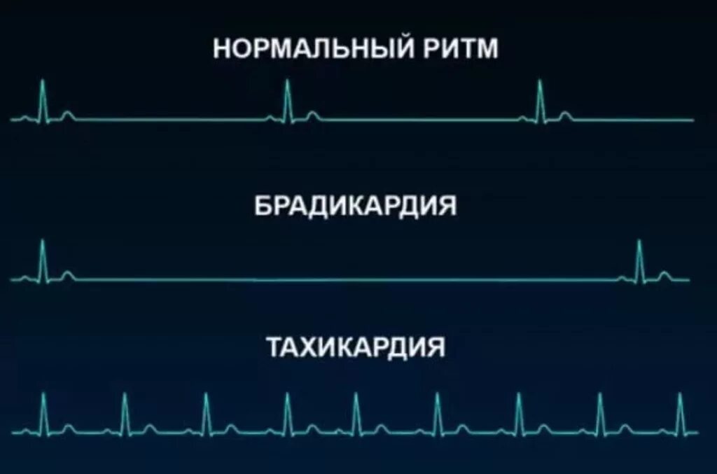 Тахикардия и брадикардия. Пульс тахикардия брадикардия. Тахикардия брадикардия аритмия. Быстрое сердцебиение. Сильный пульс причины