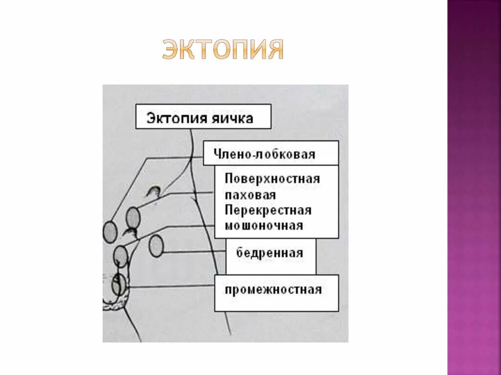 Ложный крипторхизм. Классификация крипторхизма у детей. Крипторхизм классификация. Эктопия яичка классификация. Абдоминальная форма крипторхизма у детей.