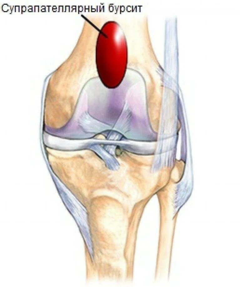 Супрапателлярная сумка коленного сустава. Препателлярный бурсит. Ретропателлярный бурсит. Инфрапателлярный бурсит коленного сустава.