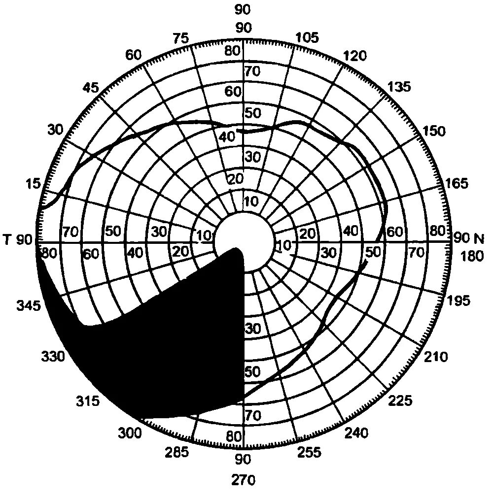 Выпадение височных полей зрения. Пропадает поле зрения. Пропадает поле зрения. Патологические изменения поля зрения. Переднеишемическая нейропатия поле зрения.